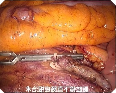 腹腔镜下直肠癌无荧光效果