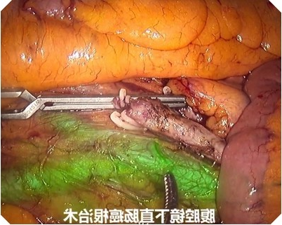 腹腔镜下直肠癌荧光效果
